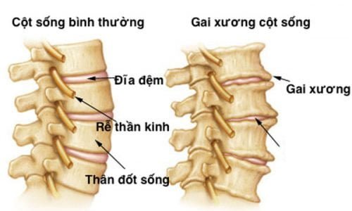 gai-xuong-dot-song-lung