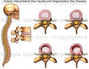 Nguyên nhân bệnh thoát vị đĩa đệm