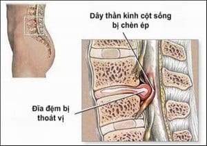 Bệnh thoát vị đĩa đệm