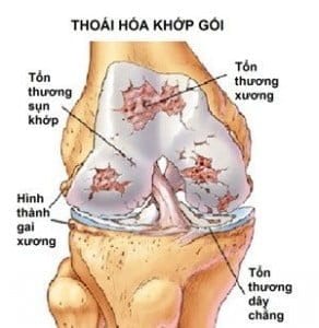 Nguyên nhân gây bệnh thoái hóa khớp