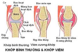 Nguyên nhân gây bệnh viêm đa khớp