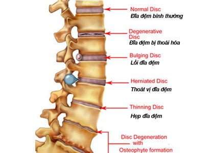 Triệu chứng và biến chứng của thoát vị đĩa đệm