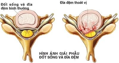 thoat vi dia dem that lung