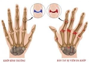 Triệu chứng bệnh viêm đa khớp