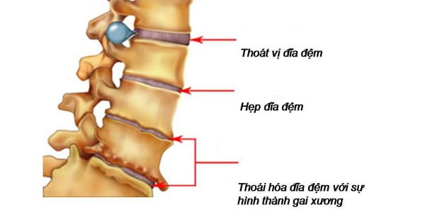 thoai-dot-dot-song-lung-co-the-hinh-thanh-gai-xuong